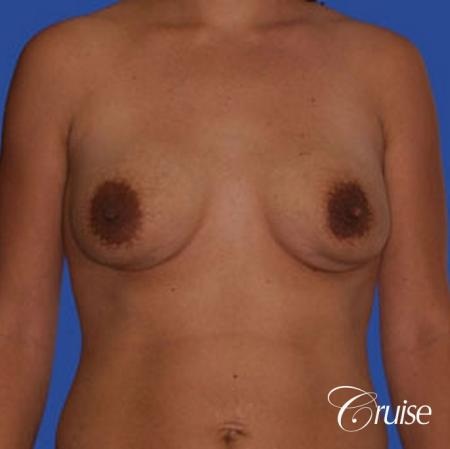 best breast revision correction of double bubble - Before Image 1