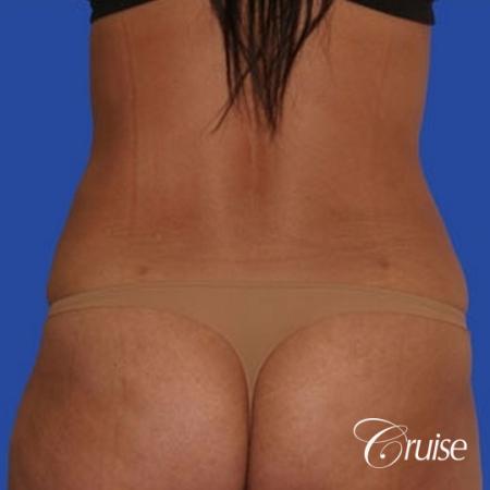 mommy makeover with silicone lollipop lift with best scars - After Image 3