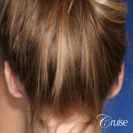 best otoplasty photos by top plastic surgeon - After Image 4