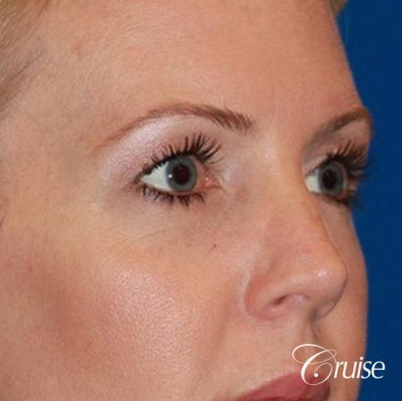 best upper eye lid results - Before Image 2