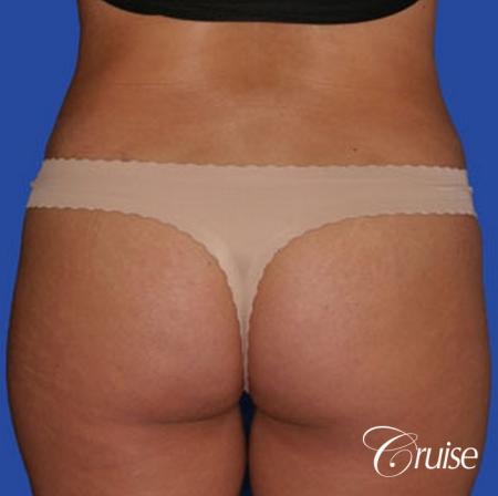 dramatic liposuction plastic surgeon does the best abdomen and flanks - After Image 1