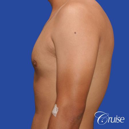 mild gynecomastia standard PA areola incision - Before Image 2