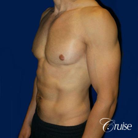 Moderate Gynecomastia -Pedicle - After Image 3