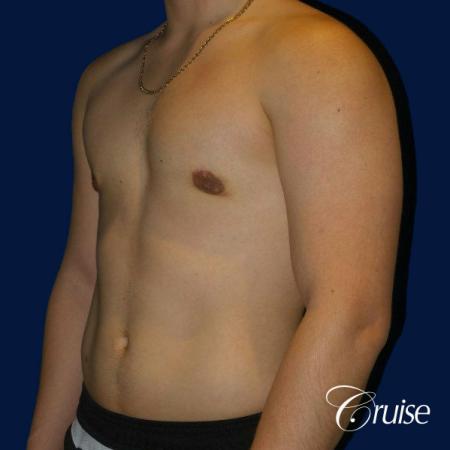 Best Gynecomastia surgeons Southern California - After Image 3