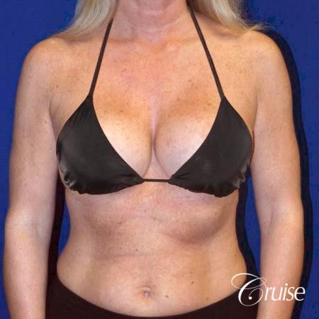 best breast lift with implants - After Image 5
