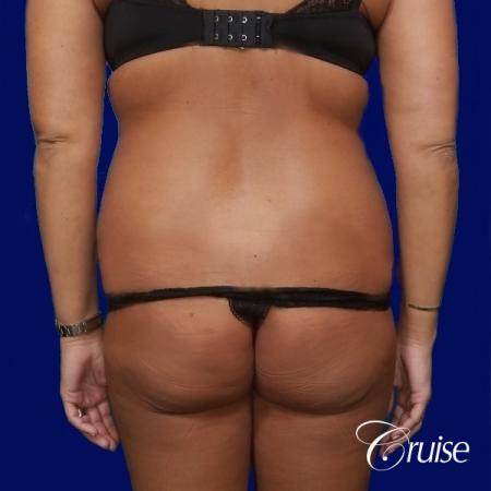Liposuction Abdomen and Flanks with Midline Contour - Before and After Image 4