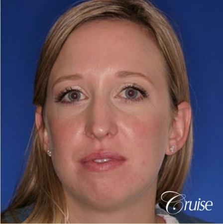 best plastic surgeon for chin augmentation implant - Before Image 1