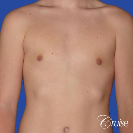 teen with pointy / puffy nipples get gynecomastia surgery - After Image 1