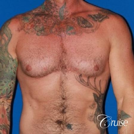 Moderate Gynecomastia -Areola Incision - Before Image 1