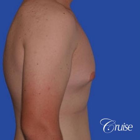 mild gynecomastia with puffy nipple from puberty - Before and After Image 2