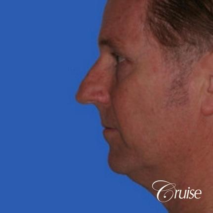 52 yr old male with medium square chin implant - Before Image 2