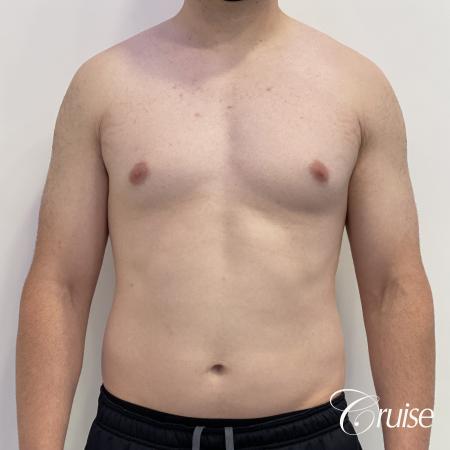 Gynecomastia: Patient 123 - Before 1
