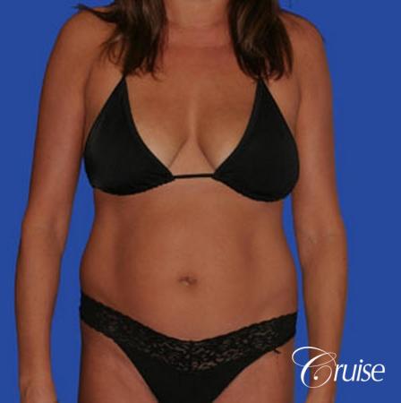 mommy makeover with best breast lift anchor with saline implants - Before Image 4