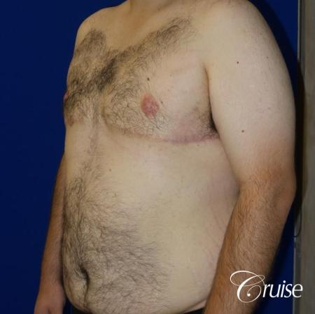 gynecomastia with free nipple graft - 1 After Image 2_2
