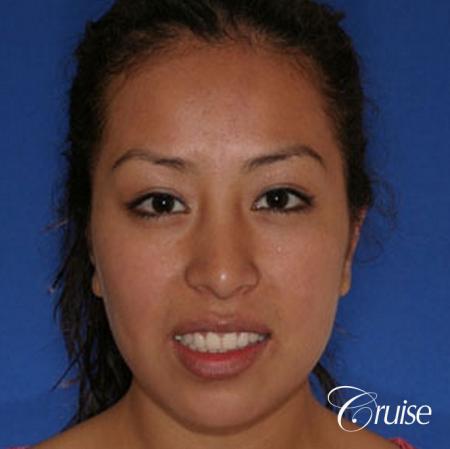 plastic surgeon does otoplasty in Newport beach - After Image 1