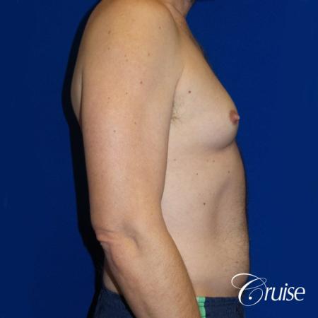 Best Gynecomastia surgeons Los Angeles - Before and After Image 3