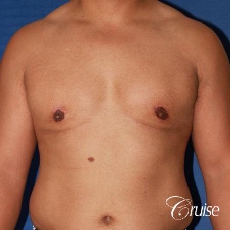 donut lift gynecomastia moderate adult - After Image 1