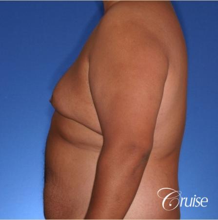 free nipple graft gynecomastia results - Before and After Image 3