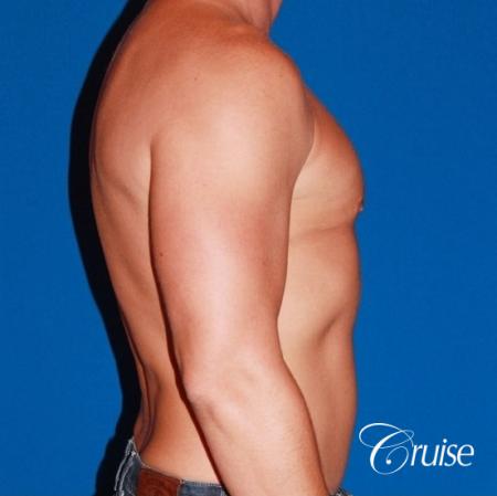 body builder with Gynecomastia puffy nipple - After Image 5