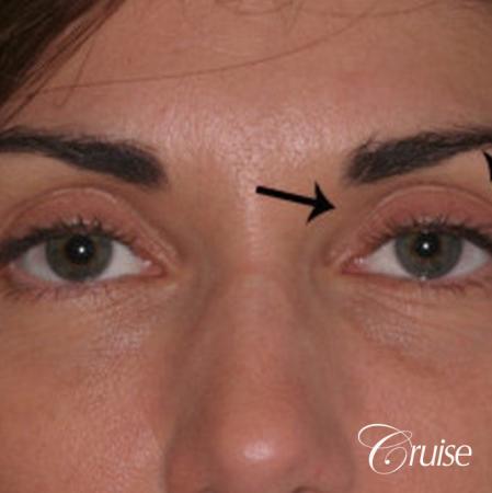 best soft tissue filler using Juvaderm - Before Image 1