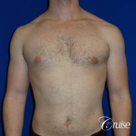 Adult gynecomastia before and after photos - After Image 1