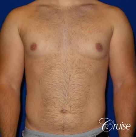 best gynecomastia results - Before Image 1