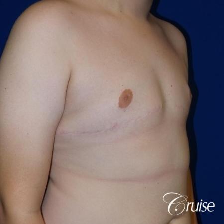young boy with gynecomastia during puberty gets surgery - After Image 3
