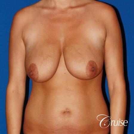 best breast lift anchor with saline implants - Before Image 1