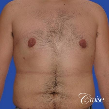 moderate gynecomastia with pointy nipples male - After Image 1