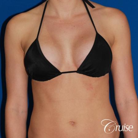 Breast Augmentation - After Image 4