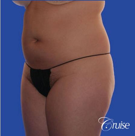best pictures of liposuction with plastic surgeon in Newport Beach - Before Image 2