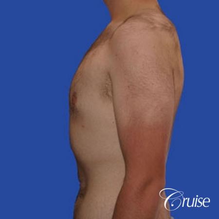 weight loss patient with gynecomastia - After Image 2