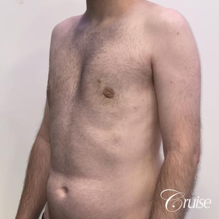 Gynecomastia: Patient 128 - After 3