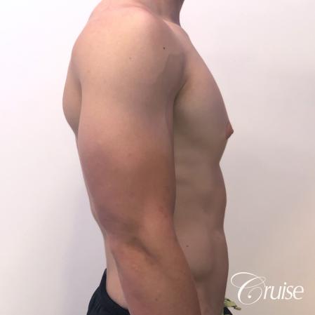 gynecomastia with puffy nipples - Before and After Image 4
