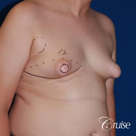 young boy with gynecomastia during puberty gets surgery - Before Image 3