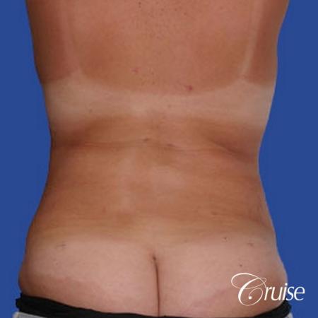 best before and after of liposuction abdomen, flanks, and upper back - After Image