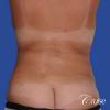 Liposuction - Abdomen / Flanks Before and After Pictures Case 14, Coeur  d'Alene, ID