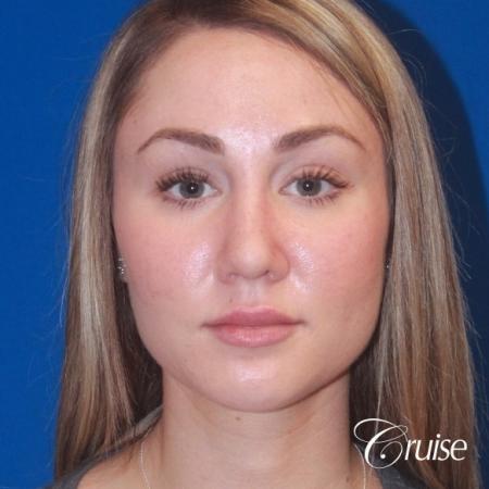 best rhinoplasty with natural results - After Image 1