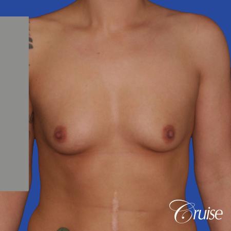 Breast Augmentation - Before Image 1