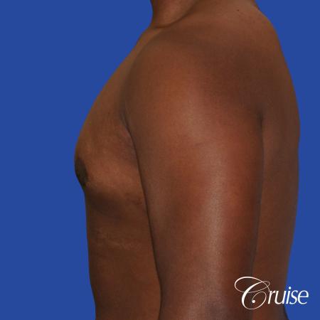 male breast moderate gynecomastia on young teen - After Image 2