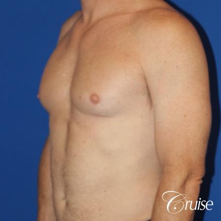 best gynecomastia results on 45 year old - Before Image 2