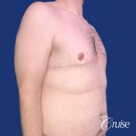 Pedicle incision Dr. Cruise Newport Beach CA - After Image 5