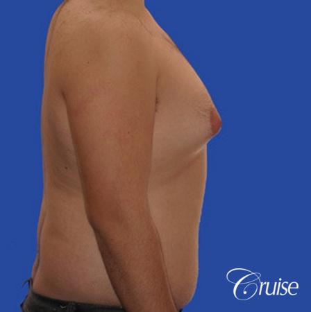male liposuction abdomen flanks with Gynecomastia - Before and After Image 5