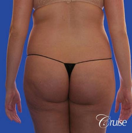 best pictures of liposuction with plastic surgeon in Newport Beach - Before Image 1