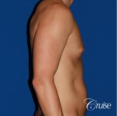 puffy nipple on low body fat - Before and After Image 5
