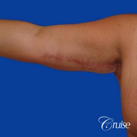 Best arm lift photos in orange county - After Image 1