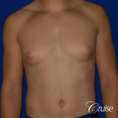 Mild Gynecomastia -Areola Incision - Before Image 1