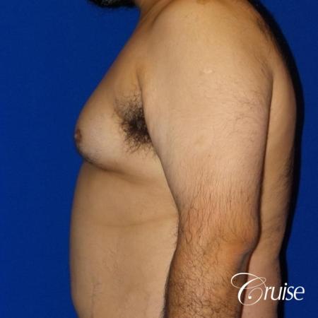 Gynecomastia -Free Nipple Graft - Before and After Image 3