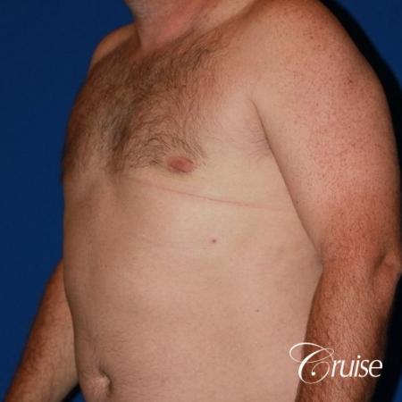 mild puffy nipple on 42 year old - After Image 3