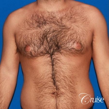 moderate gynecomastia on adult - Before 1